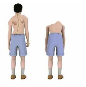 股骨头坏死的常识你了解多少 股骨头坏死的常识你了解多少