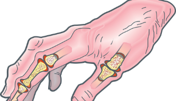 风湿类风湿有什么症状?喉咙是否沙哑竟判断类风湿 风湿类风湿有什么症状?喉咙是否沙哑竟判断类风湿