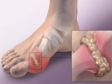 假性痛风是怎么回事? 假性痛风是怎么回事?