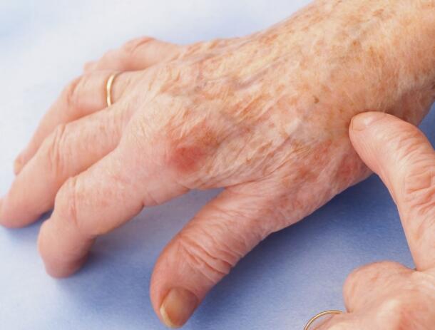 大拇指关节红肿.剧烈疼痛是痛风的典型症状表现 大拇指关节红肿.剧烈疼痛是痛风的典型症状表现