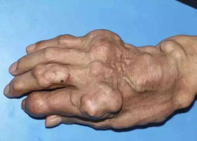 对痛风病因的全面剖析 对痛风病因的全面剖析