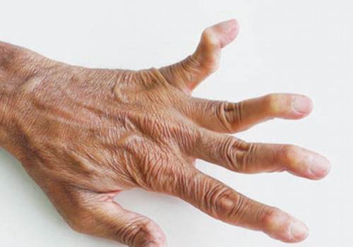 类风湿别错过很好治疗时机 类风湿别错过很好治疗时机