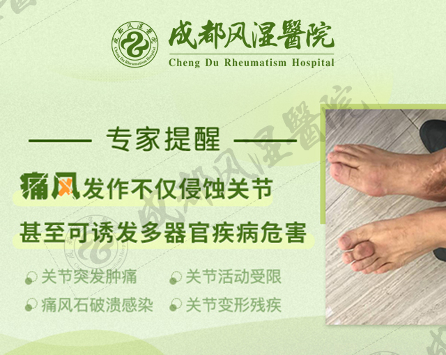 成都痛风医院哪家比较好 什么是痛风石