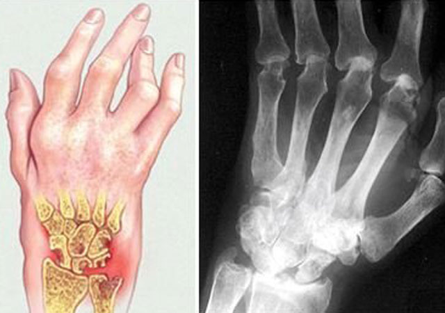 风湿病人饮食禁忌,这些食物患者不要吃 风湿病人饮食禁忌,这些食物患者不要吃